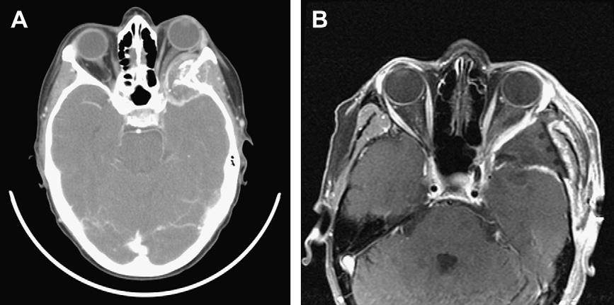 64 Chamoun & DeMonte Fig. 3. (A) Axial, postcontrast preoperative CT scan. This 54-year-old woman with known metastatic mesenchymal chondrosarcoma presented with progressive optic neuropathy.