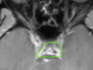 Skull Base Tumor Contouring: The Cavernous Sinus Example: Preop.