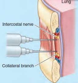 Intercostal Nerve Block One particular area of skin usually receives innervation from two adjacent nerves, there is overlap of