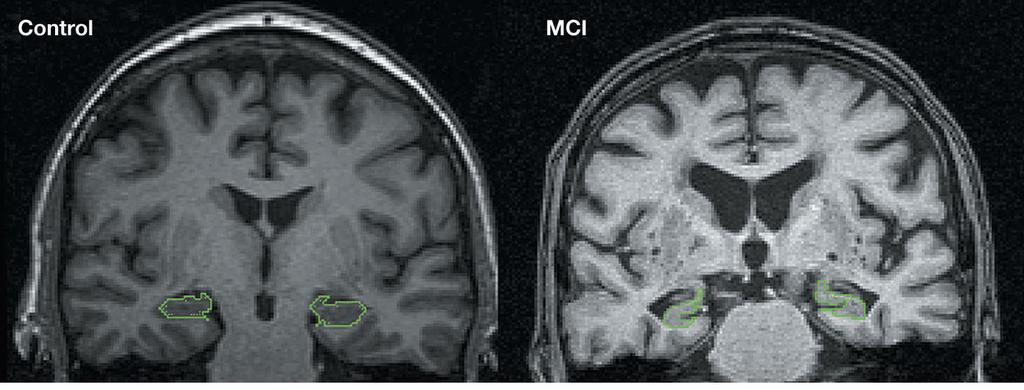Figure 3 Comparable T1-weighted coronal MRI slices perpendicular to the long axis of the hippocampus showing a normal-sized hippocampus in a control person (total hippocampal volume uncorrected for