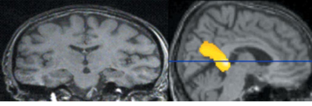Figure 5 Imaging from a 59-year-old male (MMSE = 29/30, CDR = 0.5) who met consensus criteria for MCI 23.