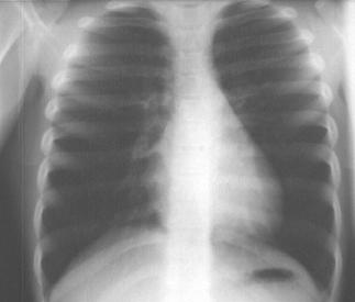 Asthma Bronchoconstriction Episodic Reversible Various