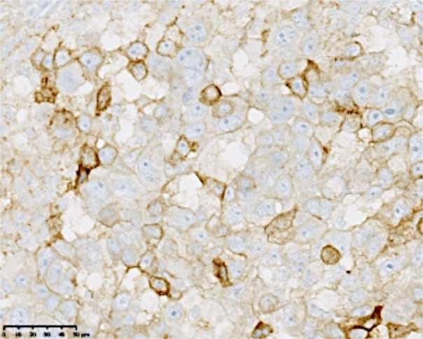 PD-L1 expression in metastatic BC PD-L1 PD-L1 IHC expression on N = 111 (%) Tumor cells 3(2.7) Immune cells 12 (10.8) Stromal cells 9 (8.1) Any cells 17(15.