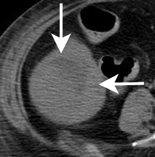The sonographic appearance may be isoechoic to surrounding normal liver, given the presence of hepatocytes that are normal to hypoechoic in appearance.