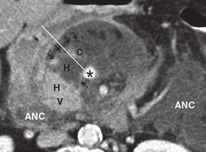Brand et al. A C Fig. 4 63-year-old woman with acute necrotizing pancreatitis who was discharged from hospital 75 days after admission.