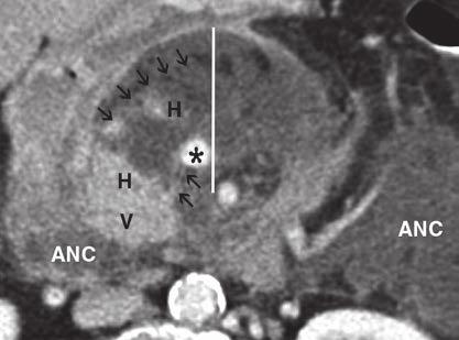 A C, Transverse contrast-enhanced CT scans at level of pancreatic head (2 cm below confluence of portal and lineal veins) (A and B) and at level of corpus (C) depict areas of necrosis (arrows) of