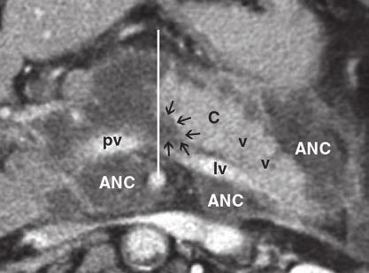 White lines represent borders that are considered to separate head and corpus of pancreas based on variable abbreviated as PAN equal area (A) and variable abbreviated as PAN anatomical (B and C).