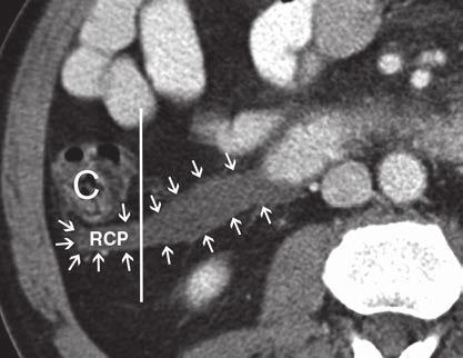 Compared with PAN equal area border that separates head and corpus (A), border that separates head and corpus according to PAN anatomical is placed more to left of pancreas (B and C).