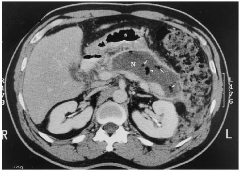 Severe Acute Pancreatitis Course: Day 1-14: 1 14: Systemic inflammatory response syndrome