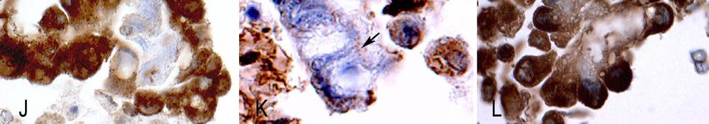 (B) Tumor cell; notice the ciliary tuft on one end and what appears to be the terminal plate (arrow), associated with true cilia.