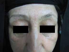 Efficacy of botulinum toxin 2a Fig. 2a Pretreatment with numerous lesions on the whole face. 3a Fig. 3a pretreatment multiple and confluent lesions in glabella area. 2b Fig. 2b After treatment.