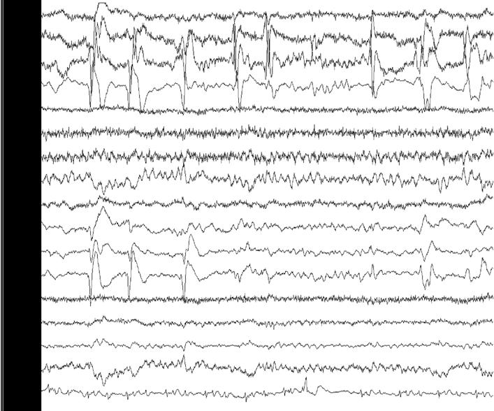 Chronic PLEDS C D Figure 1. In this figure, we can observe the EEG evolution of this patient.