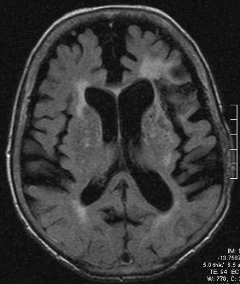 J.F. Téllez-Zenteno, et al. Figure 2. An MRI performed in 2004 showed an extensive area of encephalomalacia in the left frontal and temporal area consistent with left MCA artery stroke (axial-flair).