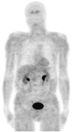 18 F-DOPA: normal biodistribution Carbidopa pretreatment Major uptake in kidneys ureter bladder