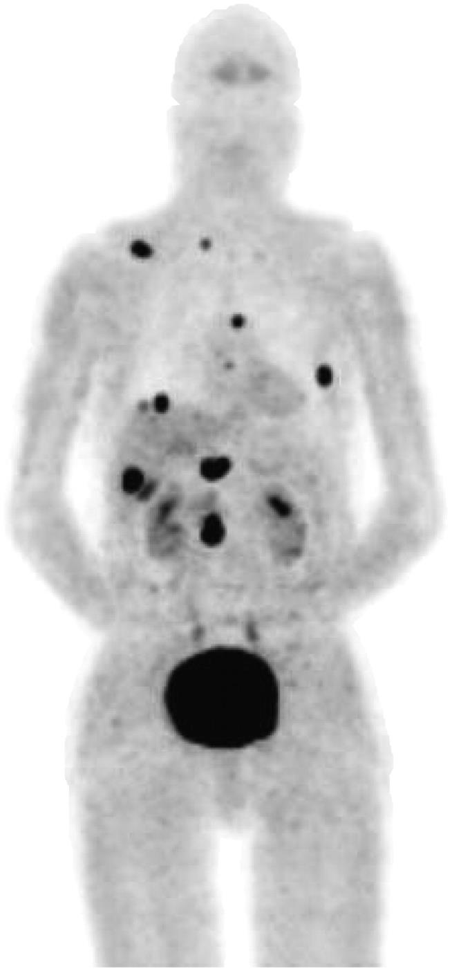 18 F-DOPA: pathological uptake in NET Carbidopa pretreatment Carcinoid in several locations abdomen
