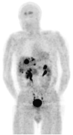 18 F-DOPA: pathological uptake in pancreatic islet NET Carbidopa pretreatment Primary malignant islet