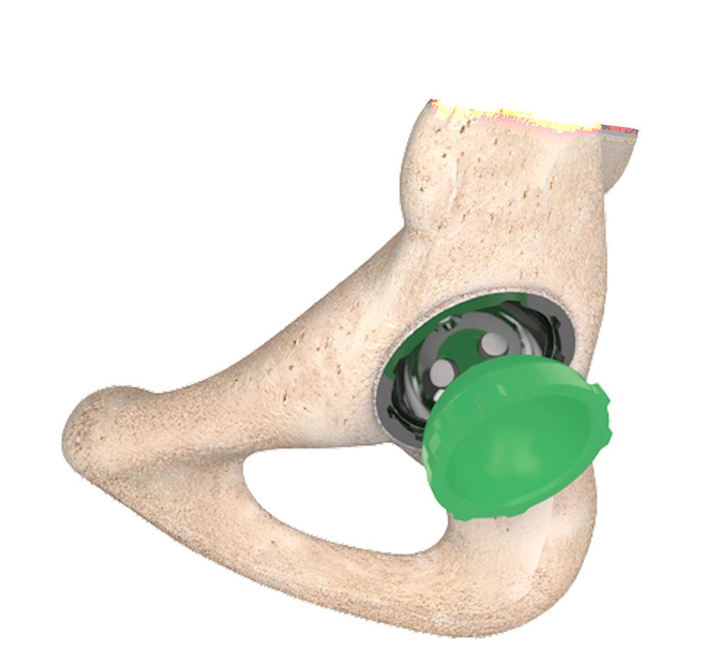 ACETABULAR CUP TRIAL INSERT ASSESSMENT AND REDUCTION Prior to poly liner