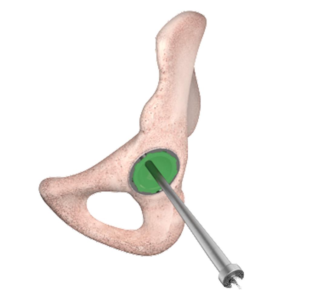 acetabular cup by hand (Fig. 9). are in place, perform a joint trial reduction.