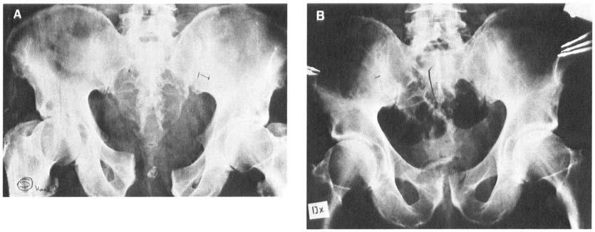 Unstable pelvic fractures 327 Figure 5 A-B. 70-year-old man. Pedestrian hit by car. A. Antero-posterior compression injury with separation of the symphysis (50 mm) and the left sacroiliac joint B.
