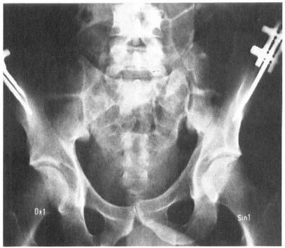 compression was released and pelvic stability was checked radiographically, with the patient bearing weight on one leg at a time.