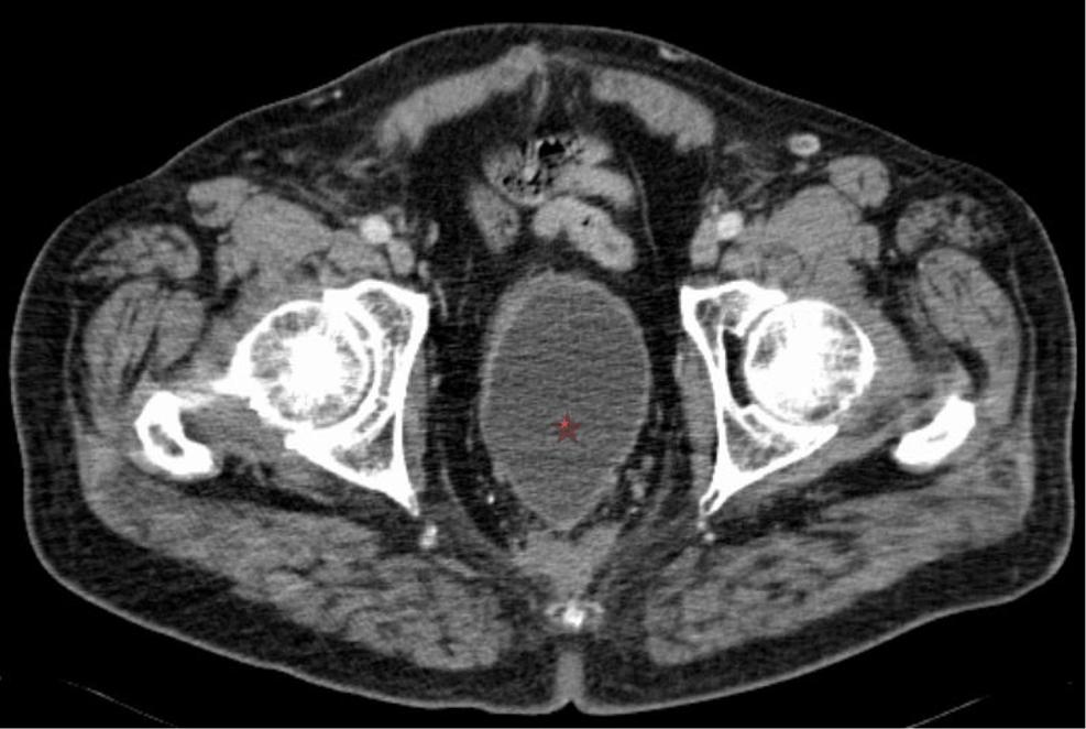 Pelvic CT reveled diffuse wll thickening (rrows in ) of the colonl nstomosis (note the surgicl stples) due to histologiclly proven firotic stenosis Fig.