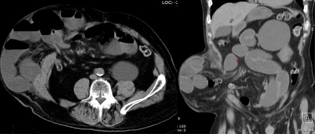 Fig. 7, Ptient with n incisionl externl herni. A cluster of fluid nd ir-filled dilted owel loops is found inside the hernil sc on the right flnk (strs).