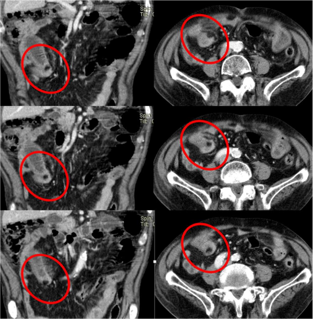 Strngultion occurs with typicl findings s descried ove, such s owel wll thickening, free fluid nd ft strnding [19] (Fig. 9).
