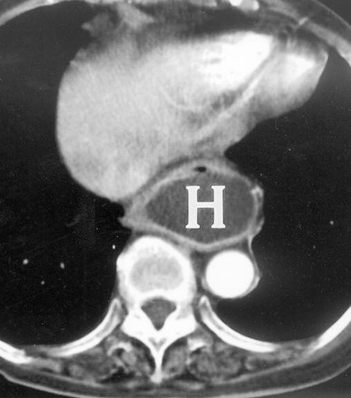 Contrast-enhanced CT scan shows floating inhomogeneous mass with entrapped air (arrow).