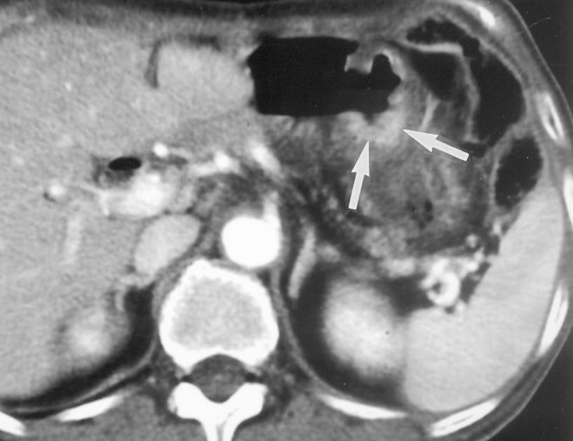 1038 Fig. 4. 63-year-old woman with afferent loop syndrome after Billroth II operation.
