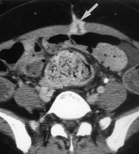 CT After Gastric Carcinoma Resection Fig. 10.