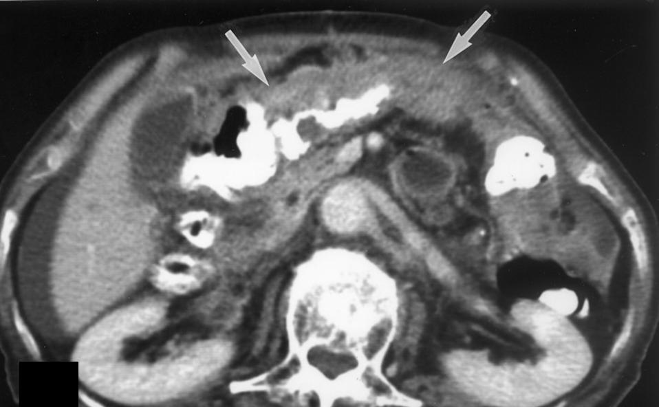 Fig. 11. 62-year-old woman with tumor recurrence along abdominal incision.