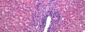 lymphocytes centrally in the portal tracts (Malcom