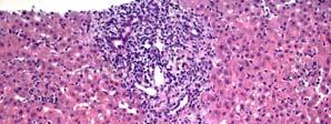 inflammation with polymorphs and lymphocytes (Peron