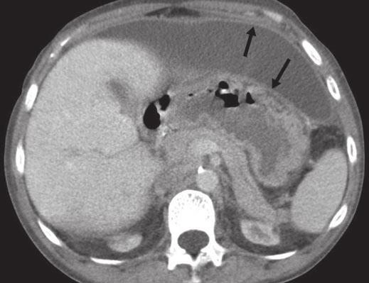Ti et al. Fig. 1 31-year-old woman previously on continuous ambulatory peritoneal dialysis who presented with symptoms of persistent nausea and vomiting.