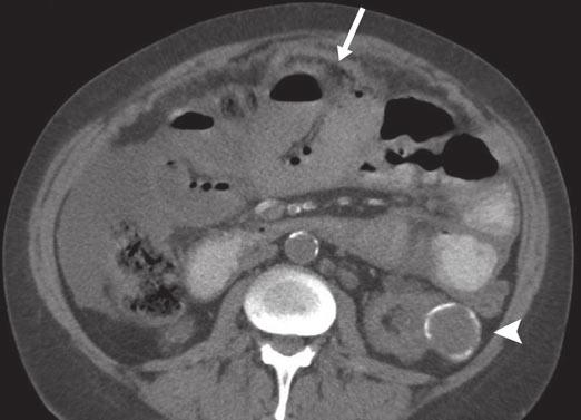 , Contrast-enhanced abdominal scan shows fluid within abdomen surrounded by thickened, enhancing peritoneum. Peritoneal thickening (arrows) is smooth and regular.