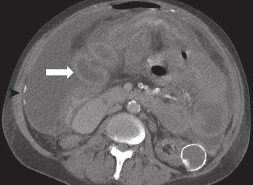 bdominal scan obtained using oral and IV contrast media shows there has been progression of irregular, nodular peritoneal thickening and shows enhancement (black arrows).