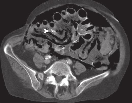 Encapsulating Peritoneal Sclerosis in CPD Patients Fig. 3 59-year-old woman on continuous ambulatory peritoneal dialysis who presented with acute abdomen.