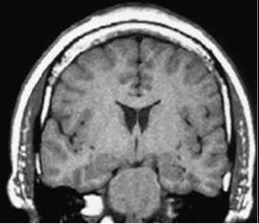 AD MRI brain scan Normal Alzheimer's disease