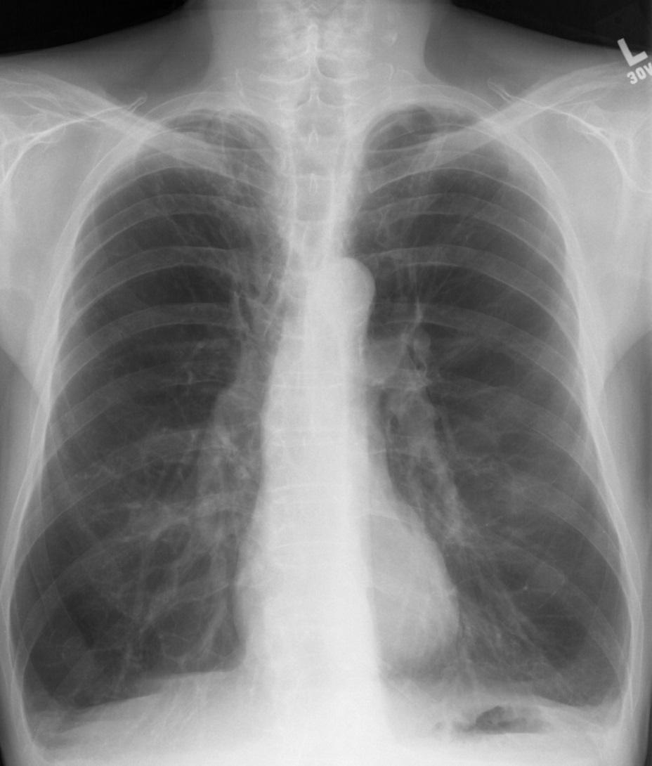 Normal in many patients Possible CXR findings: Lung hyperinflation Widened AP diameter