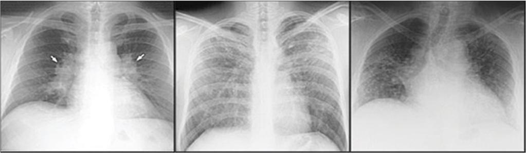 Sarcoidosis Diagnosis Granulomas in lung tissue biopsy Typical