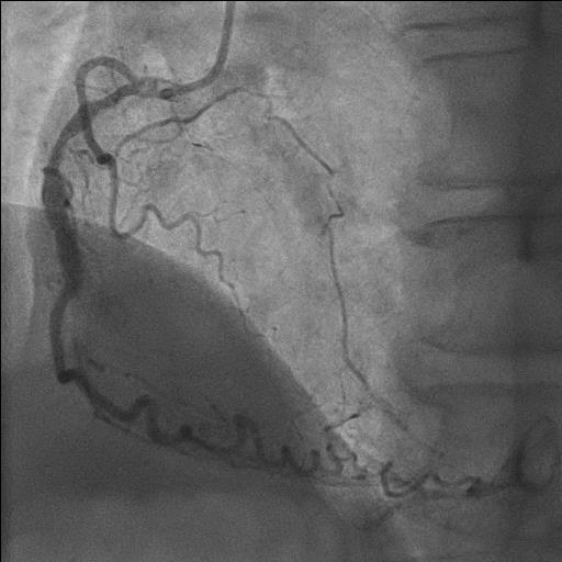 Coronary angiogram: RCA-proximal total occlusion with LCA-collaterals, LAD and RCX with coronary sclerosis. June 19 th, 2017.
