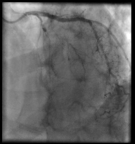 T-wave inversion in V1 V4. Coronary angiogram: LAD-proximal total occlusion, RIVP-collaterals. RCA with 50% ostial stenosis and good result after proximal stenting.