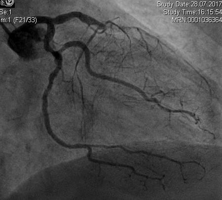 presentation: instable angina ECG abnormality: Sinusrhythm, 76/min, LAH,.