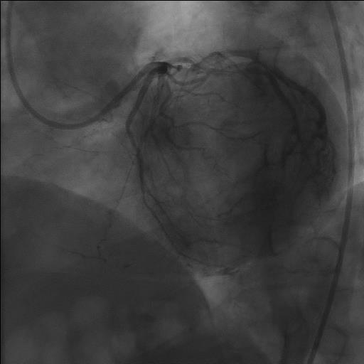 Transthoracal echocardiography: LV- concentric hypertrophy (IVSd 17mm), no LVOT Coronary angiogram: obstruction or gradient, LVEF 73%, diastolic dysfunction type I.