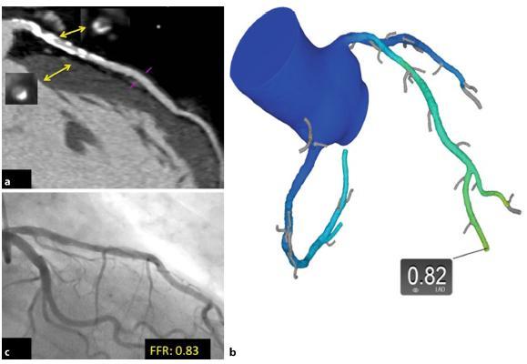 FFR-CT in diffusely calcified coronary