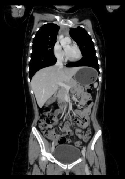 patient with NHL post treatment showed no sizable axillary thoracic or abdominopelvic lymph nodes (white