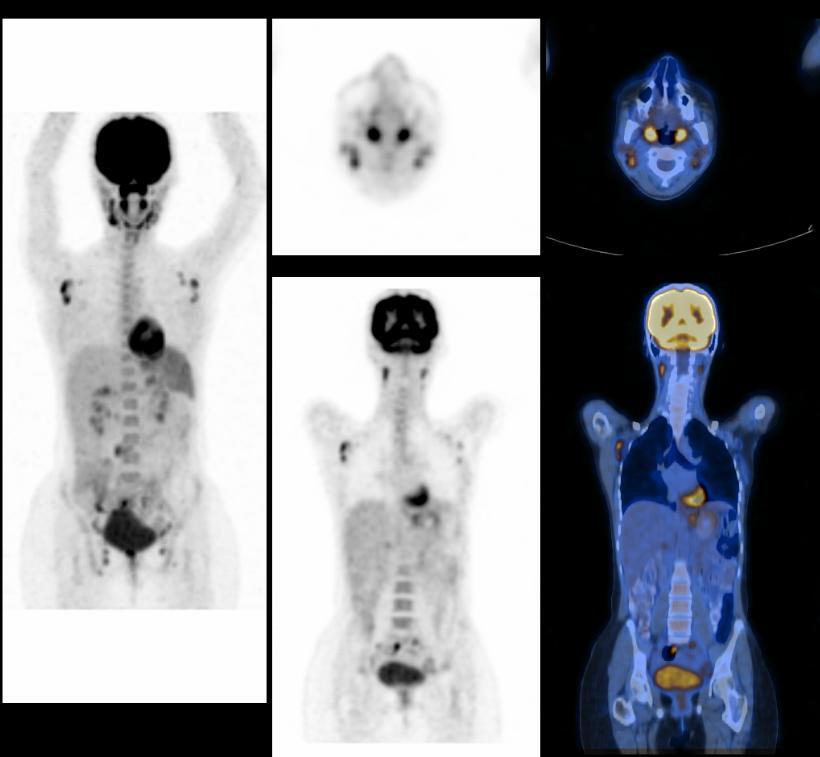(B)PET- CT of the same patient showed still residual bilateral cervical, bilateral axillary, abdominal