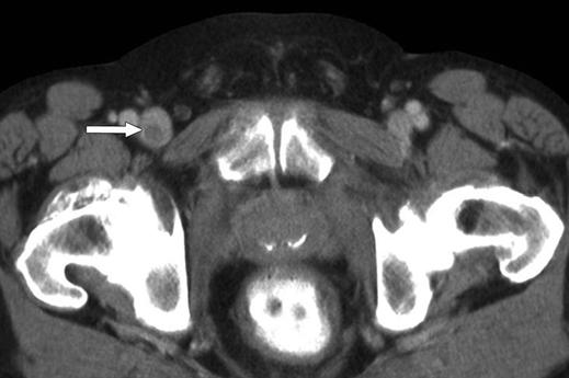 CT of Cancer Patients with Asymptomatic Venous Thromboembolic Disease A C E Fig.