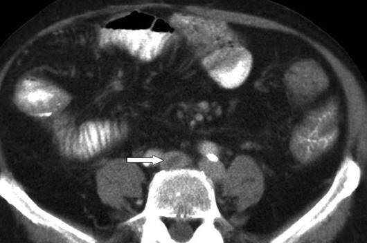 A, CT image shows right iliofemoral deep vein thrombosis (arrow).