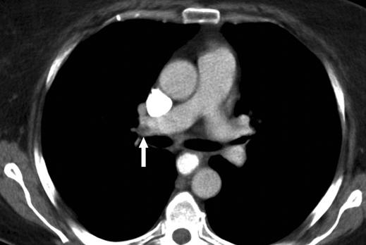 Findings on CT pulmonary angiograms were positive in two of the three patients.